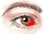 lasik-eye-surgery-recovery_subconj-hemorrhage